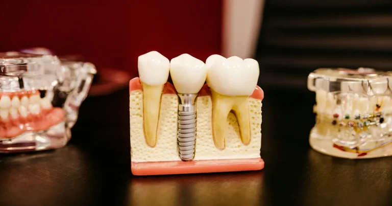 Dental Implants: Procedure, Benefits, Risks & Cost Factors Guide